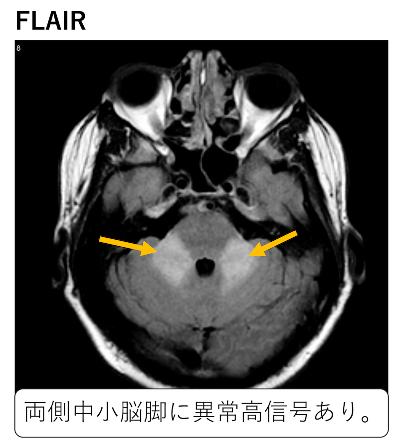 T2WIで中小脳脚に異常高信号を呈する鑑別疾患(MCP sign)